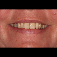 Anita Toner before